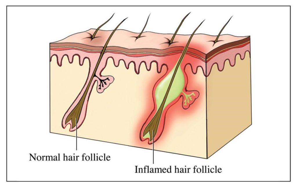 Follicular Edema Red Skin Bumps Golden Pulse Clinic
