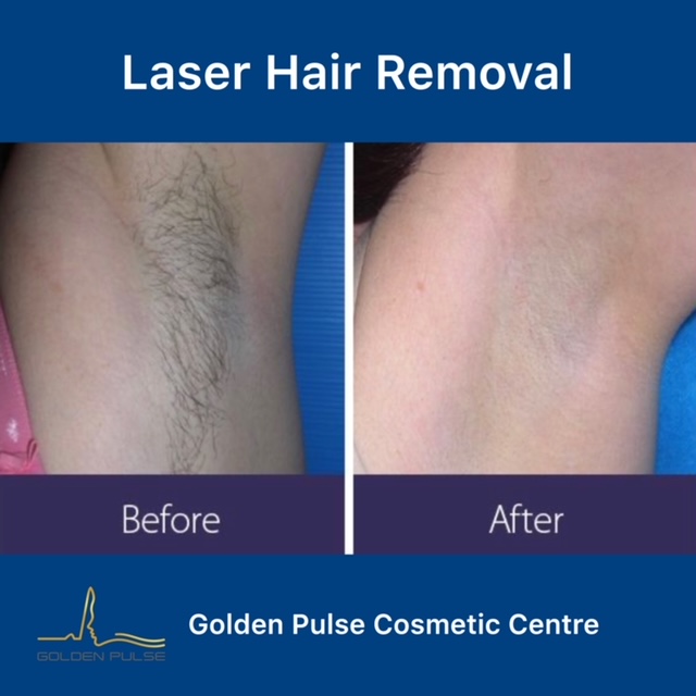 Laser Hair Removal Golden Pulse Laser Clinic Before After 1
