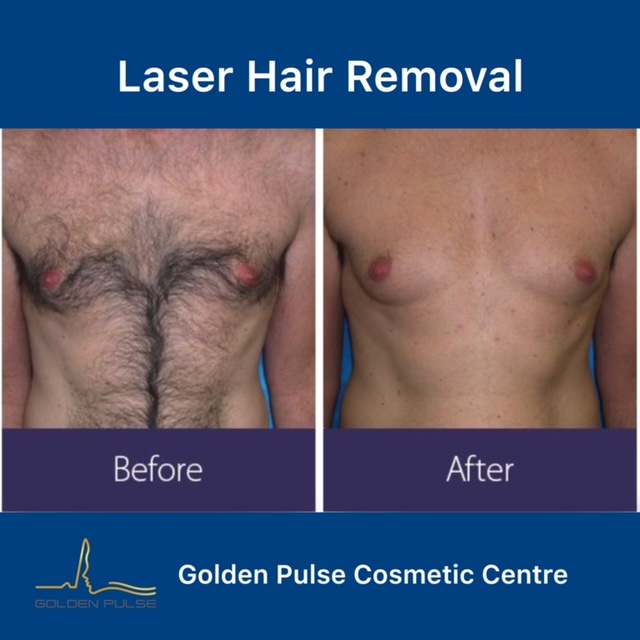 Laser Hair Removal Golden Pulse Laser Clinic Before After 2