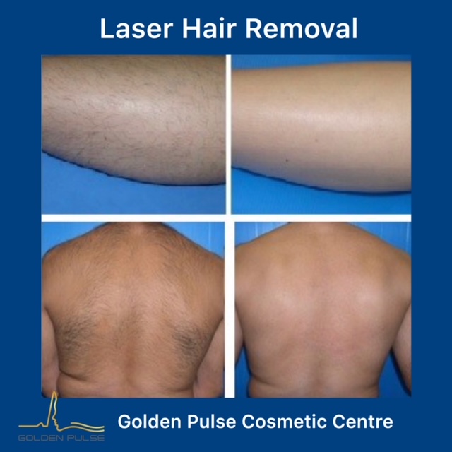 Laser Hair Removal Golden Pulse Laser Clinic Before After 3