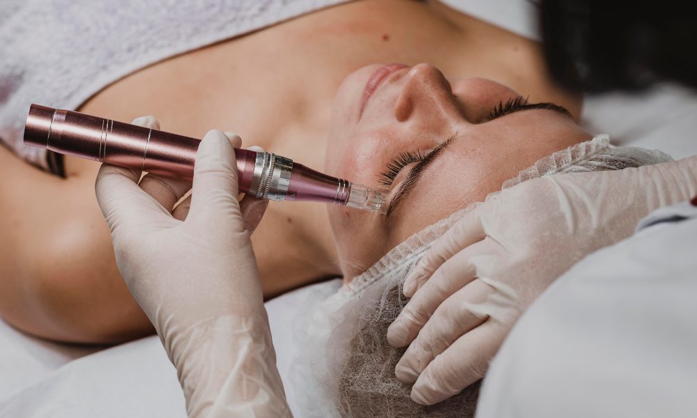 Microneedling at Golden Pulse Richmond Hill Cosmetic Clinic
