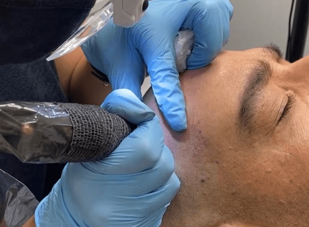 Start Your Scalp Micropigmentation Small Business