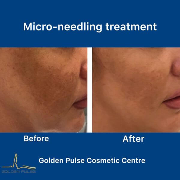 microneedling RESULTS