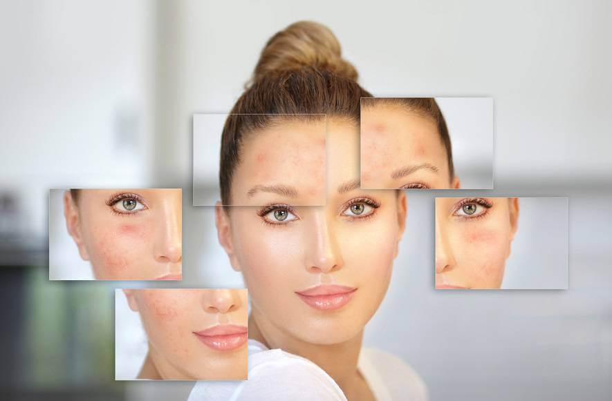 Microdermabrasion for Acne