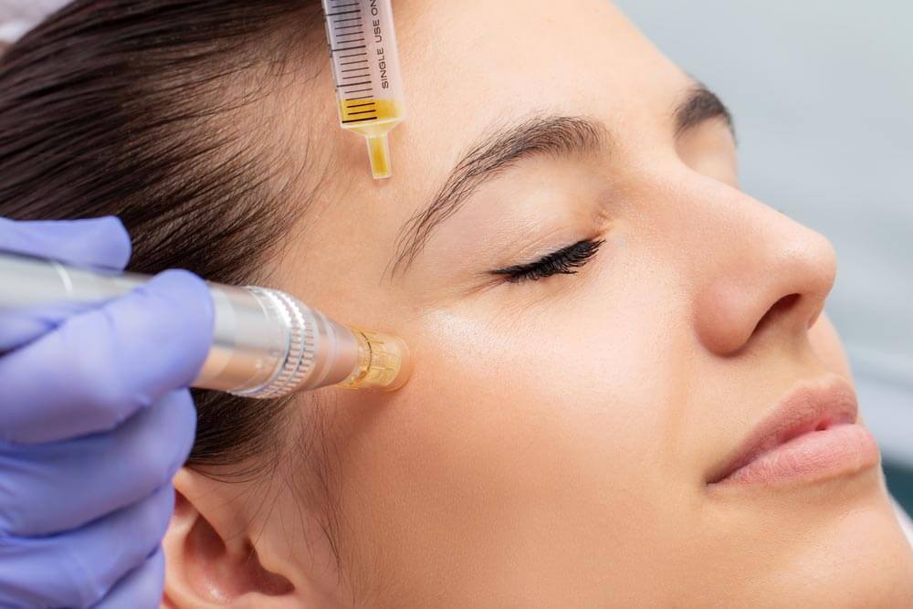Can I Exercise 24 Hours after Microneedling?