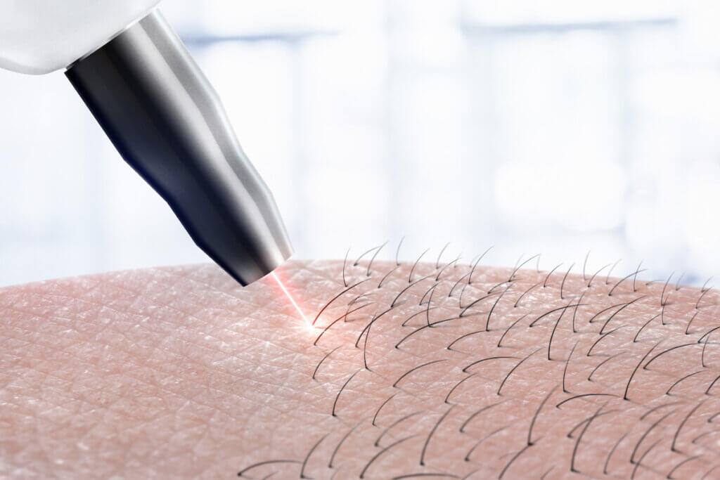 Can I Use Laser Hair Removal For Thin Hair?