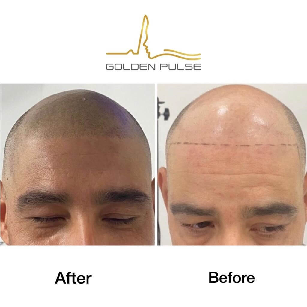 Start Your Scalp Micropigmentation Small Business