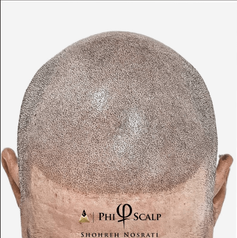 What is the difference between SMP and Hair Transplant?