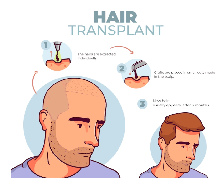 What is the difference between SMP and Hair Transplant?