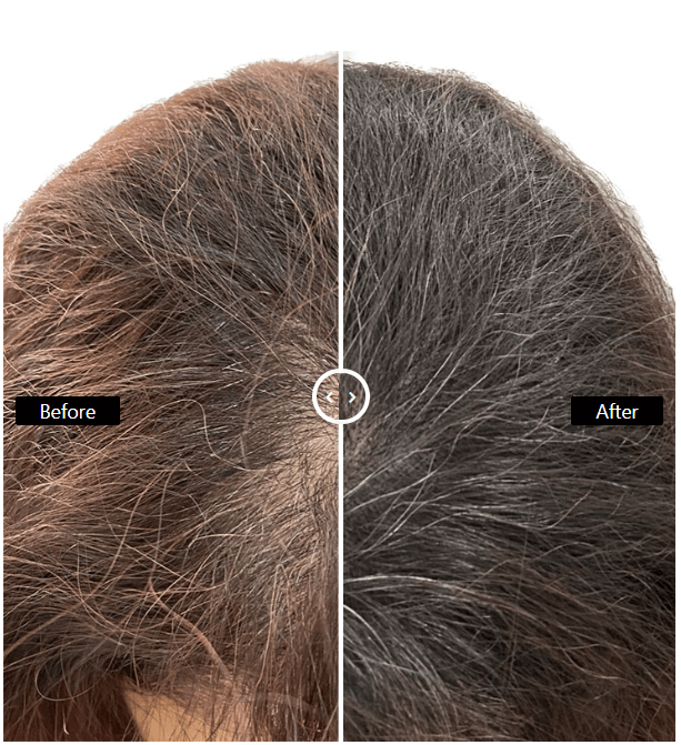 Does Scalp Micropigmentation look real?