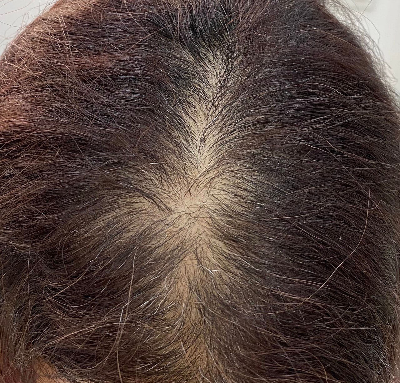Women Hair Thinning Solution