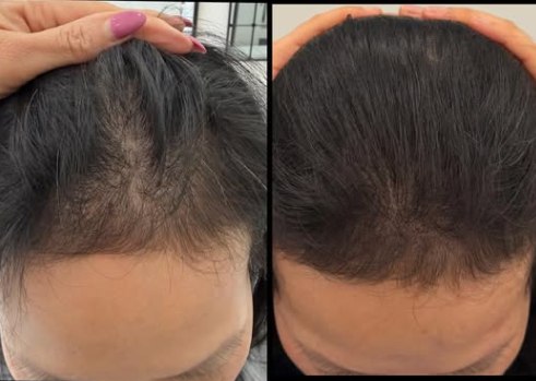 SMP for Women Hair loss solution