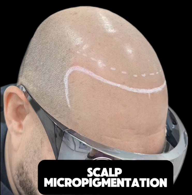 Hairline Restoration by SMP in Toronto and Richmond Hill and Vaughn