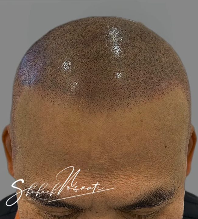 Hairline Restoration by SMP in Toronto and Richmond Hill
