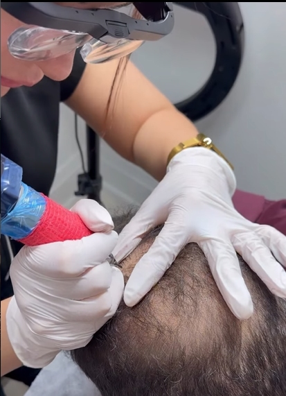 SMP for Hair Transplant