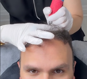 Scalp Micropigmentation After Hair Transplant